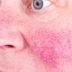 Yes, Windy Weather Can Trigger Rosacea—and So Can These 6 Other Things