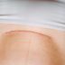 This Woman Performed Her Own Cesarean Section—and Survived
