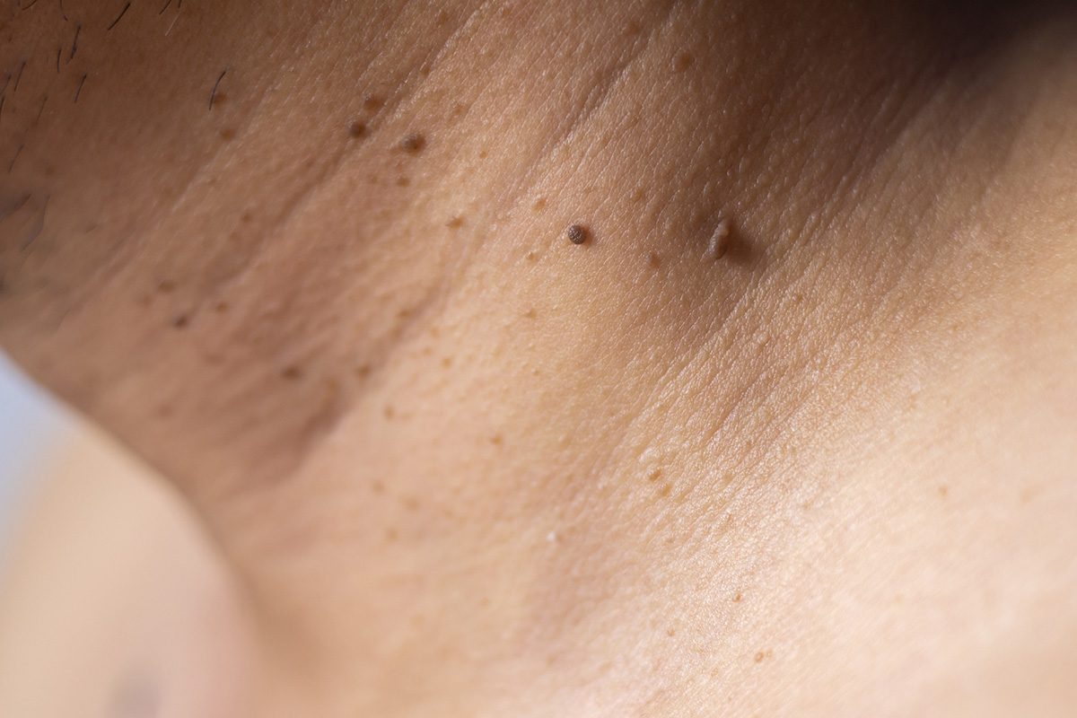 How To Get Rid Of Skin Tags The Right Way, According To Expert Dermatologists Gettyimages 2179226383